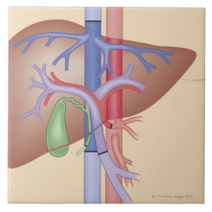 Liver Transplant Procedure Tile