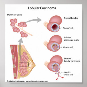 Lobular breast cancer, labelled diagram. poster