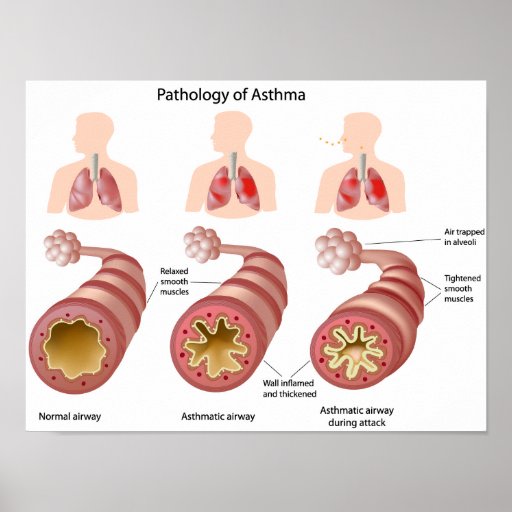 Lung disease Asthma Poster | Zazzle