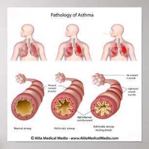 Lung disease Asthma Poster
