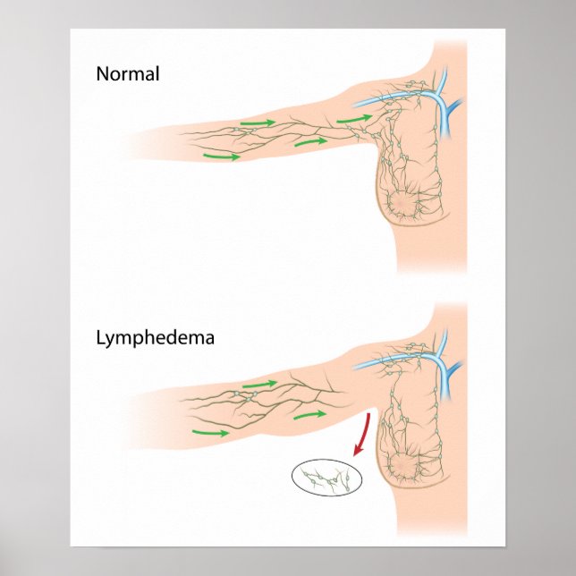 lymphedema arm disease diagram poster (Front)