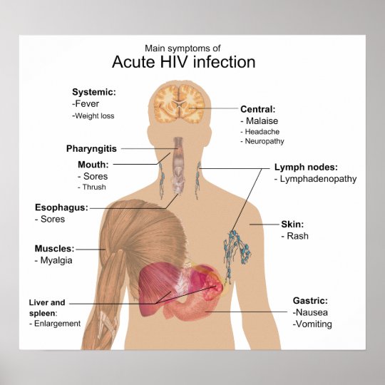 Main Symptoms of Acute HIV Infection Poster | Zazzle.co.uk