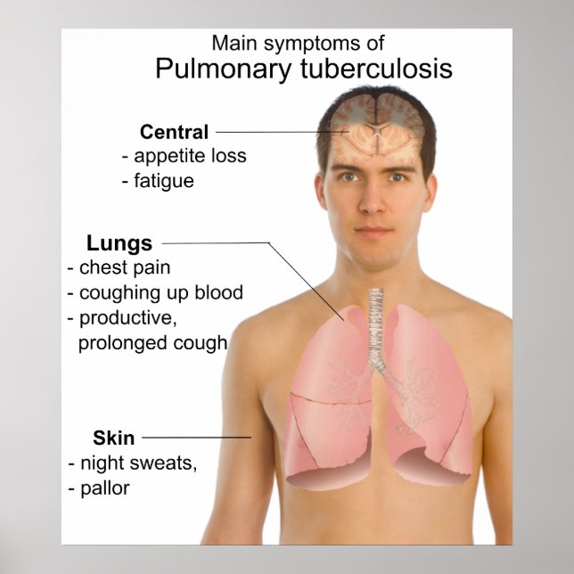 Main Symptoms of Pulmonary Tuberculosis Chart (Front)