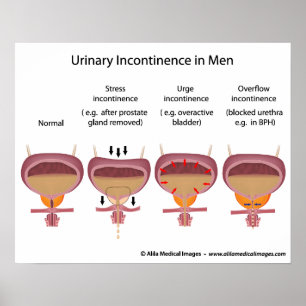 Male urinary incontinence poster