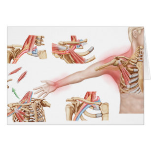Medical Illustration Detailing Thoracic Outlet