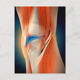 Medical Illustration: Inflammation In Knee Postcard