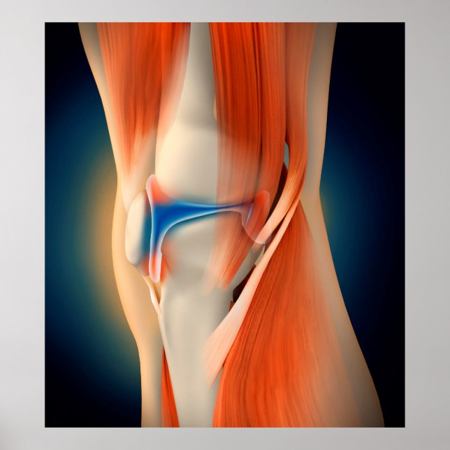 Medical Illustration: Inflammation In Knee Poster (Front)