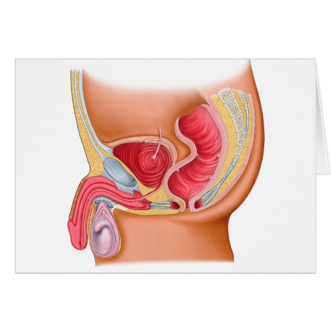 Medical Illustration Of A Rectourethral Fistula (Front Horizontal)