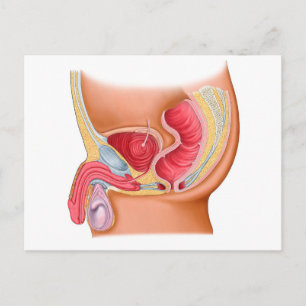 Medical Illustration Of A Rectourethral Fistula Postcard
