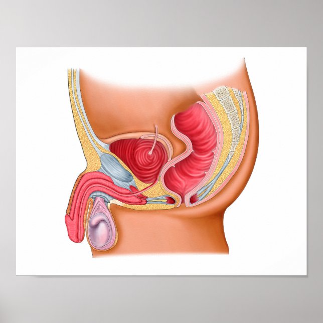 Medical Illustration Of A Rectourethral Fistula Poster (Front)