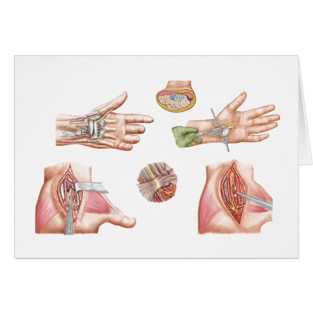 Medical Illustration Showing Carpal Tunnel (Front Horizontal)