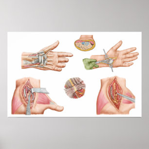 Medical Illustration Showing Carpal Tunnel Poster