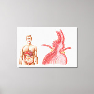Medical Ilustration Of A Hiatal Hernia In The Canvas Print