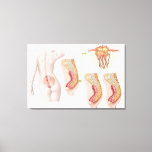 Medical Ilustration Of A Pilonidal Cyst Canvas Print