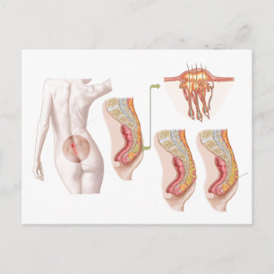 Medical Ilustration Of A Pilonidal Cyst Postcard