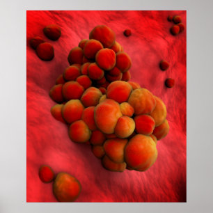 Microscopic View Of Tumour 2 Poster