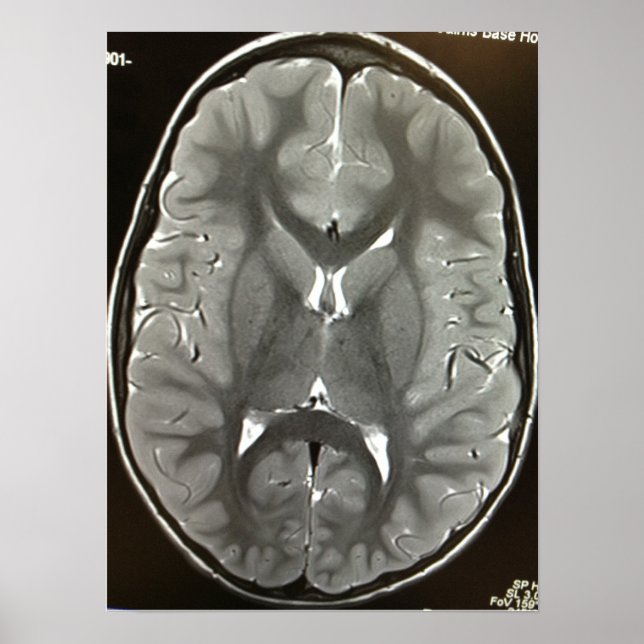 MRI Brain Poster (Front)