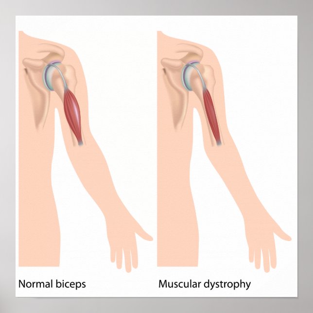 Muscular dystrophy Poster (Front)