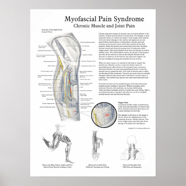 Myofascial Pain Syndrome Poster (Front)