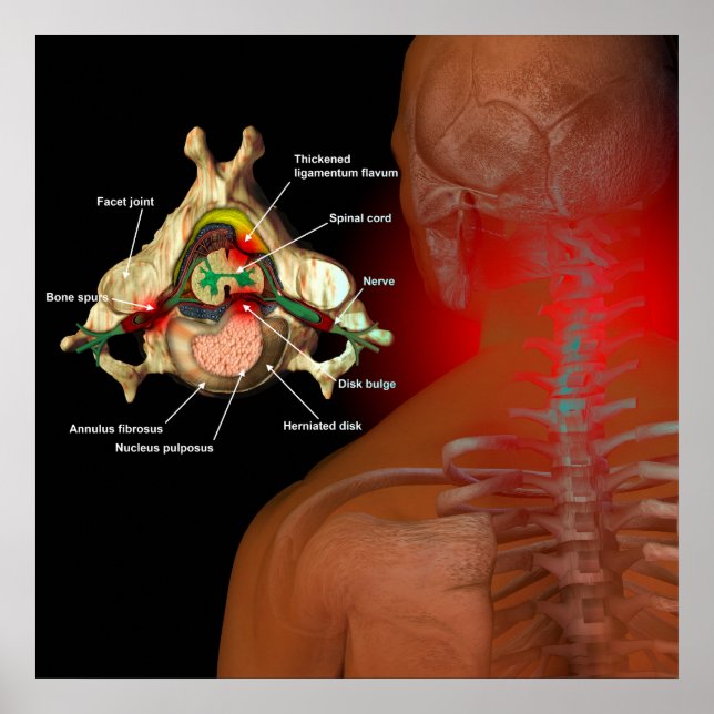 Neck pain poster (Front)