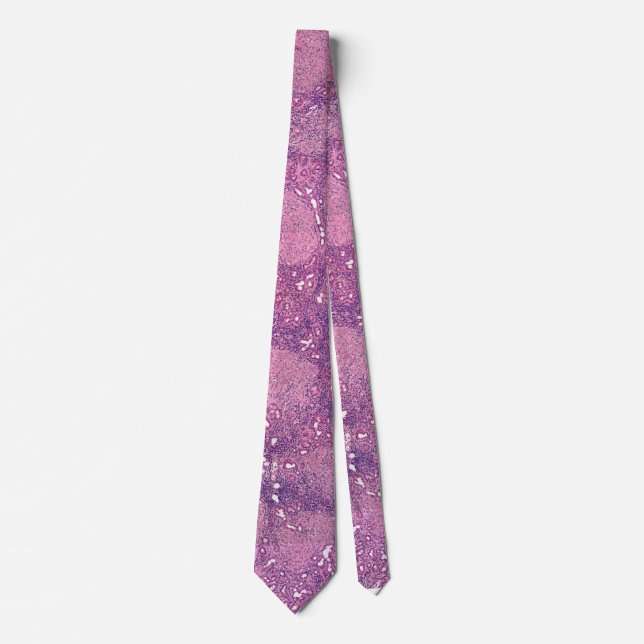 Neck tie sarcoidosis (Front)