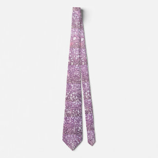 Neck tie showing adenoid cystic carcinoma