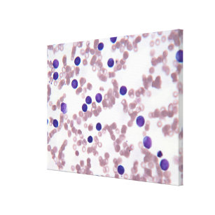Neoplastic Lymphocyte Cells Canvas Print