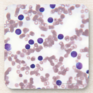 Neoplastic Lymphocyte Cells Coaster