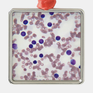 Neoplastic Lymphocyte Cells Metal Tree Decoration