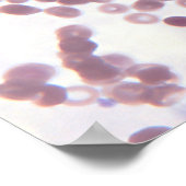 Neoplastic Lymphocyte Cells Poster (Corner)