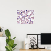 Neoplastic Lymphocyte Cells Poster (Home Office)