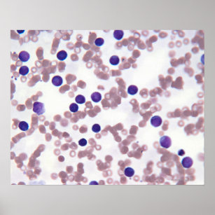 Neoplastic Lymphocyte Cells Poster