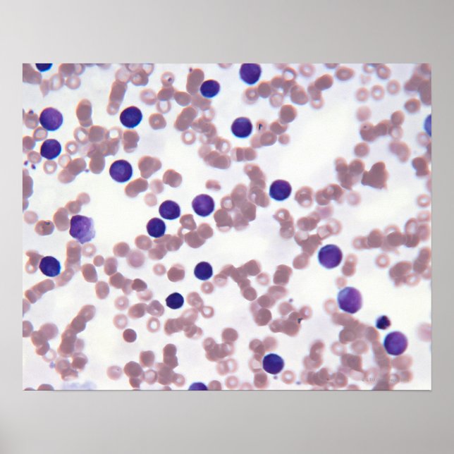 Neoplastic Lymphocyte Cells Poster (Front)
