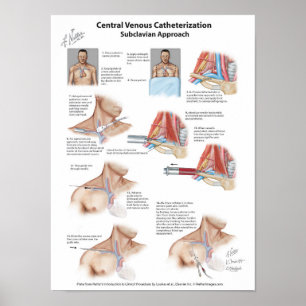 Netter Chart: Central Venous Catheterization Poster