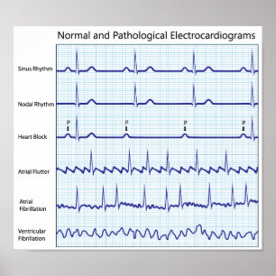 Normal and pathological ecg Poster