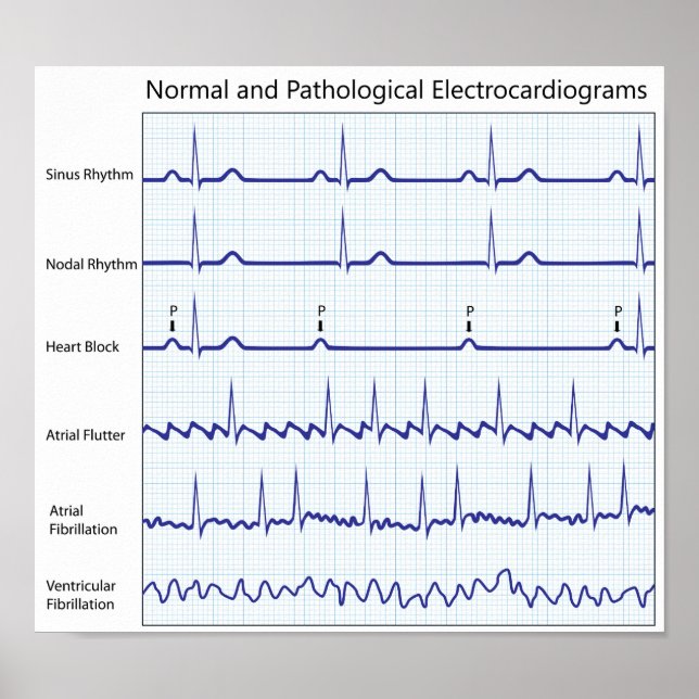 Normal and pathological ecg Poster (Front)