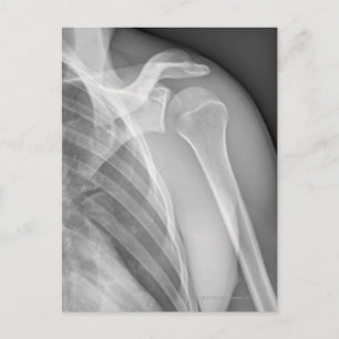 Normal shoulder. X-ray of the healthy left Postcard