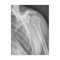Normal shoulder. X-ray of the healthy left