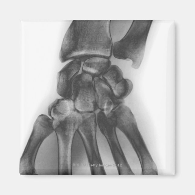 Normal wrist, X-ray Magnet (Front)