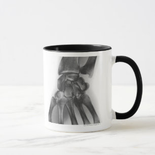 Normal wrist, X-ray Mug