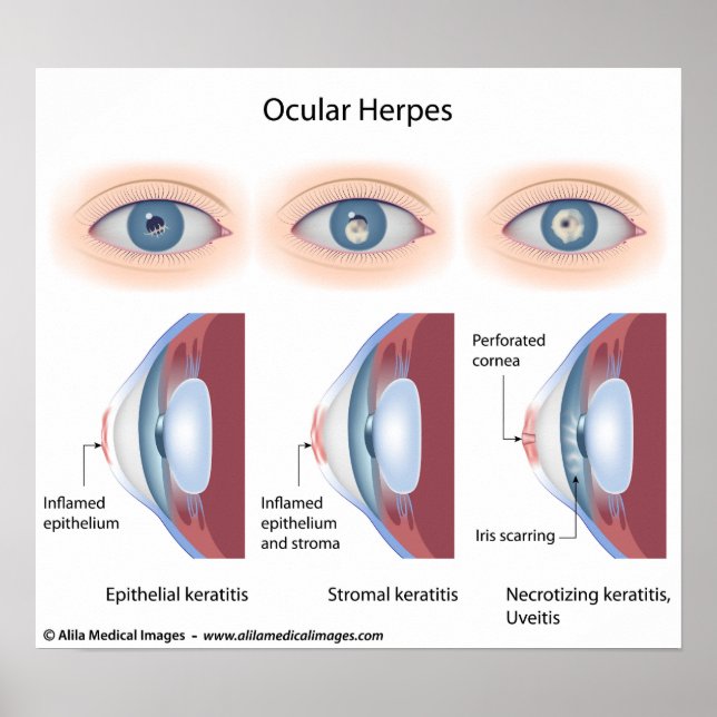 Ocular herpes infection, labeled diagrams poster (Front)