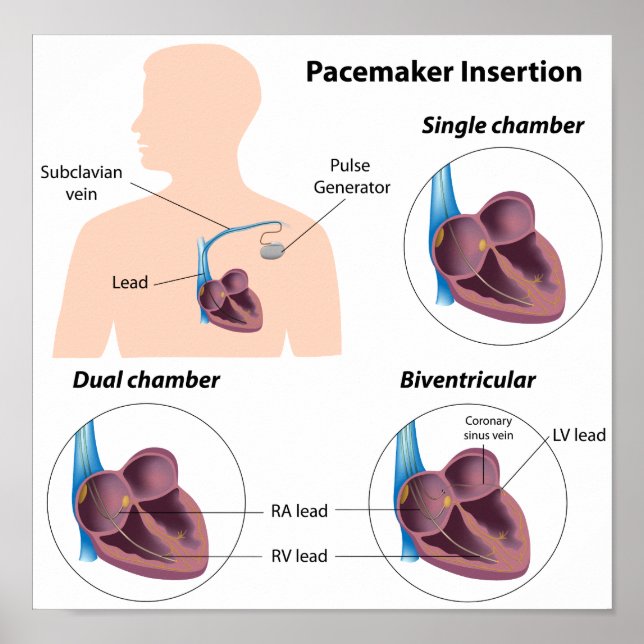 Pacemaker insertion surgery Poster (Front)
