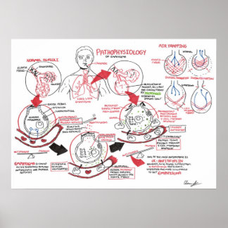 Pathophysiology of Emphysema Poster