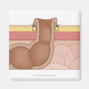 Permanent Colostomy Magnet