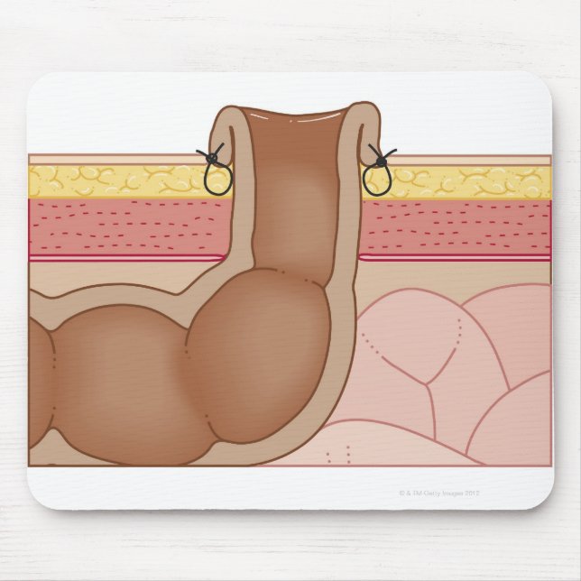 Permanent Colostomy Mouse Mat (Front)