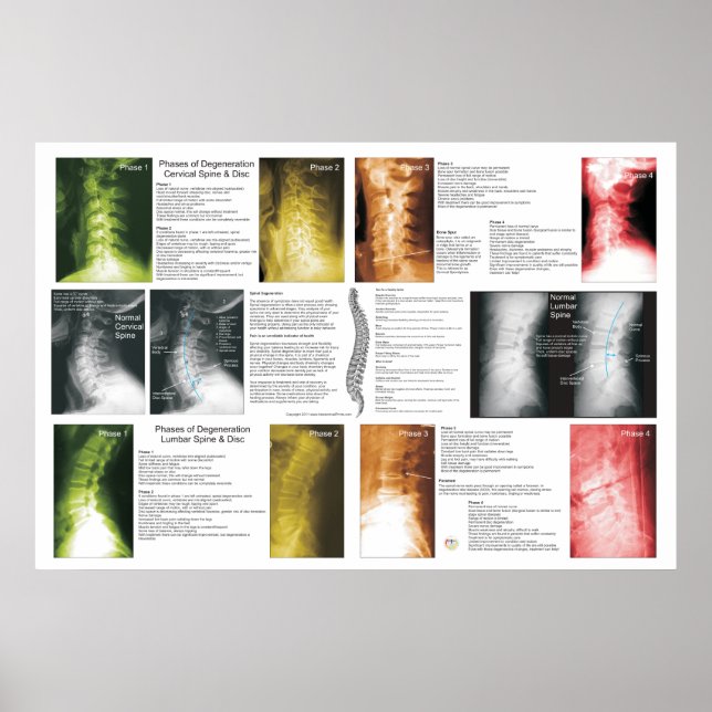 Phases Cervical Lumbar Spinal Degeneration Poster (Front)