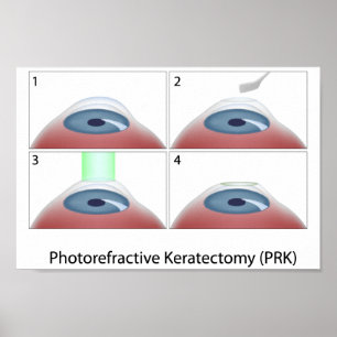 Photorefractive Keratectomy (PRK) poster