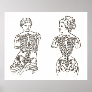 Physical Impact of Wearing Corsets Medical Print
