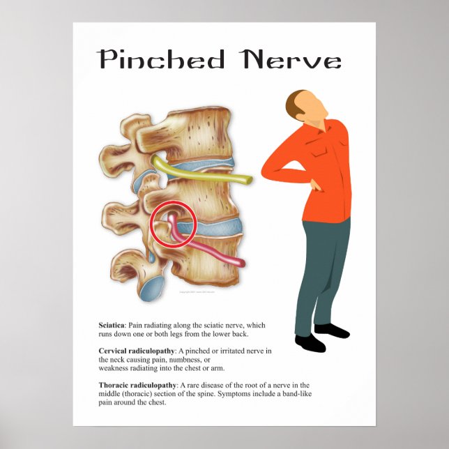 Pinched Nerve Physical Therapy Chiropractic Chart (Front)