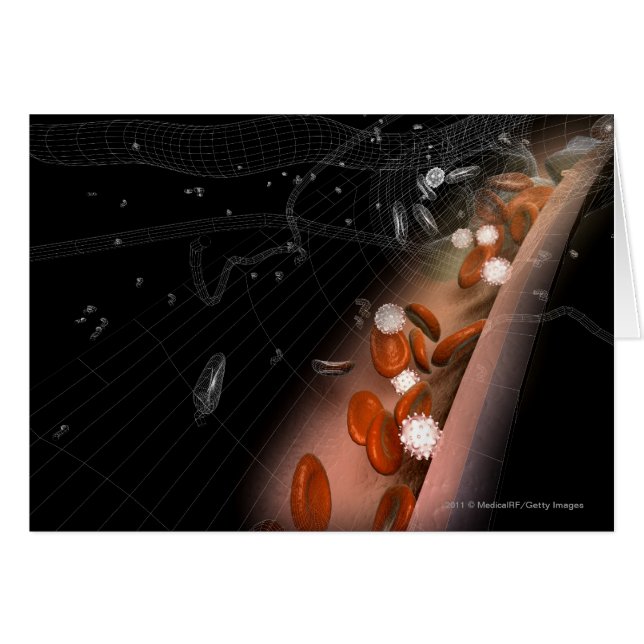 Plaque in the arteries (Front Horizontal)